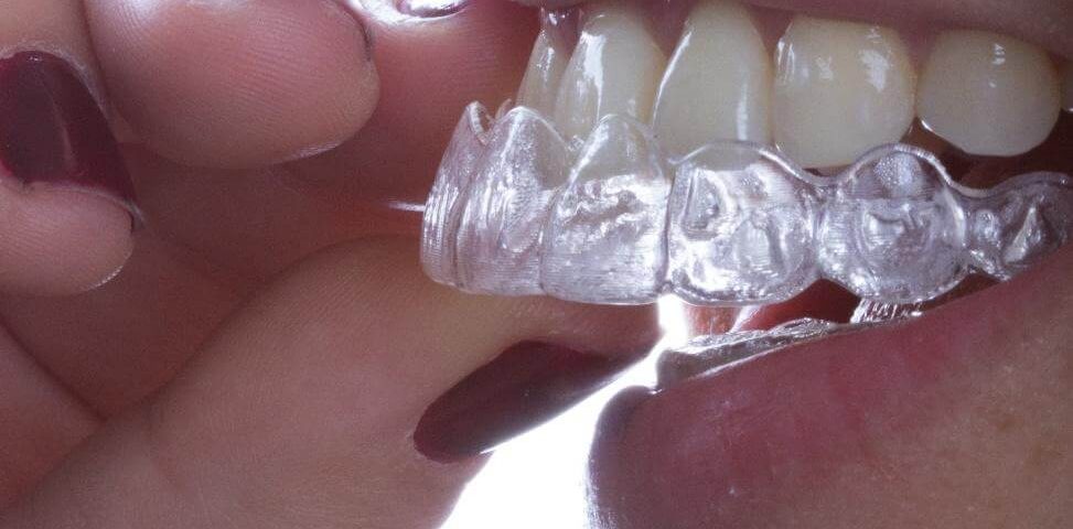 Alinhador estético dental