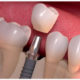 Implante dentário em SP