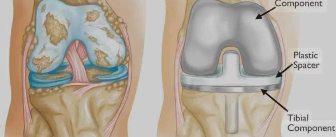 prótese de joelho tempo de recuperação