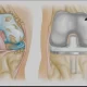 prótese de joelho tempo de recuperação