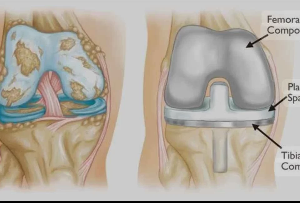 prótese de joelho tempo de recuperação