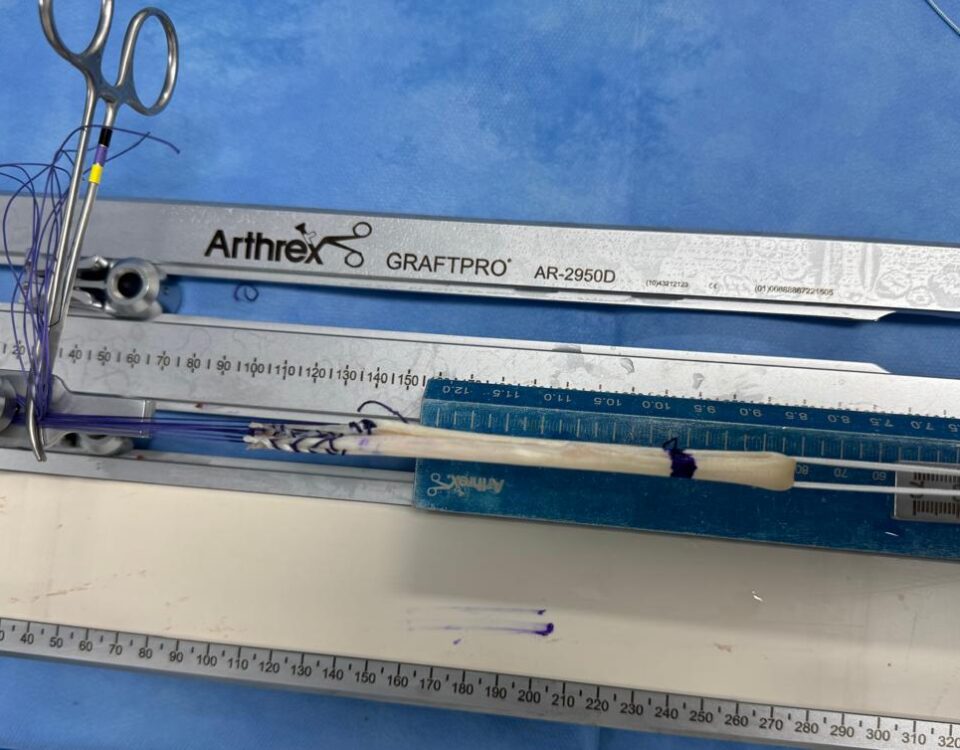 qual o tempo de recuperação de uma cirurgia de lca