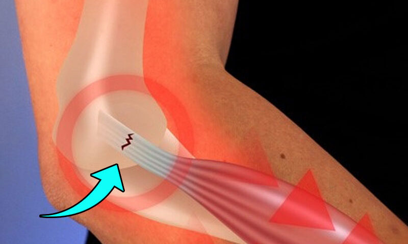 Especialista em cotovelo