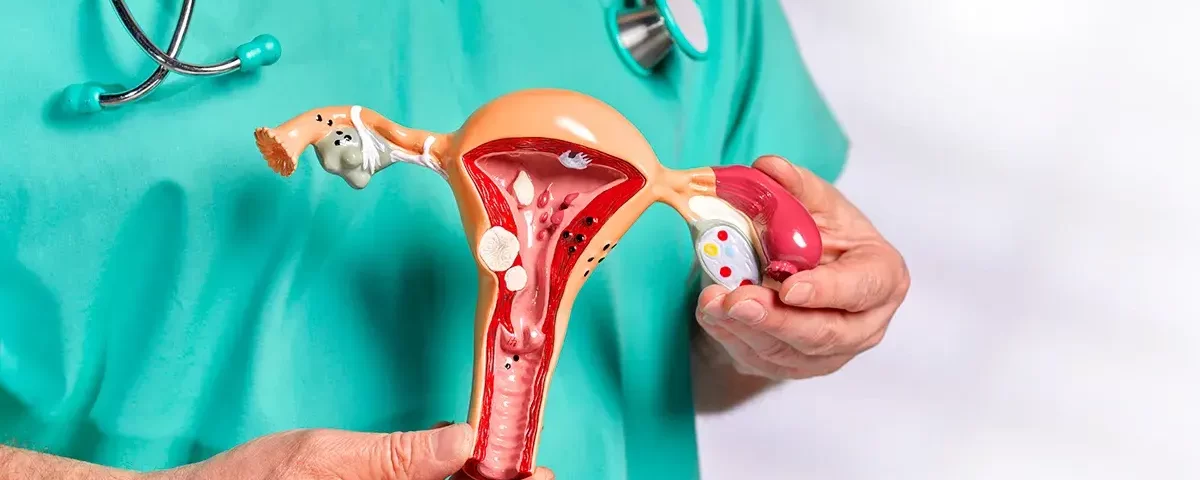 Ginecologista Especialista em Endometriose