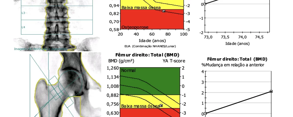 O melhor médico para tratamento de osteoporose