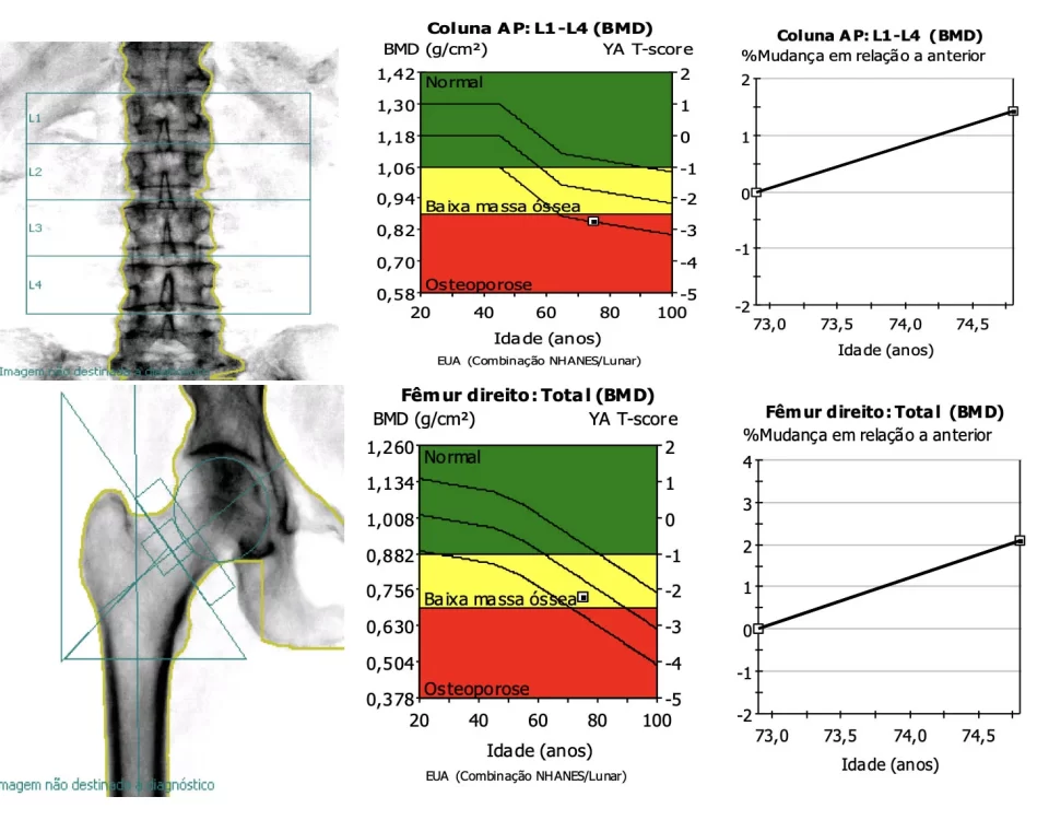 O melhor médico para tratamento de osteoporose