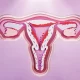O Que é Endometriose Profunda