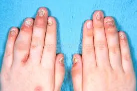 Reumatologista que trata artrite psoriasica