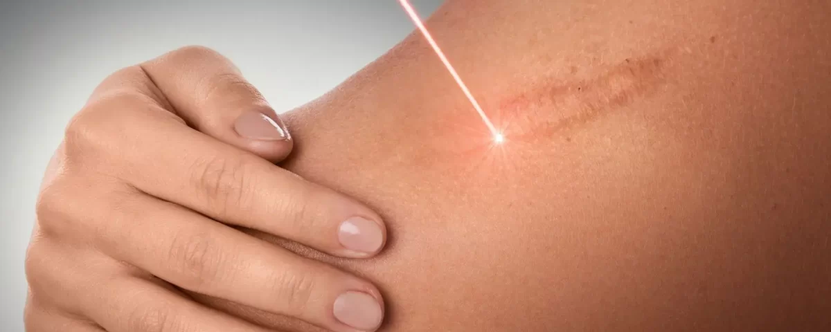 Tratamento com Laser em Guarulhos