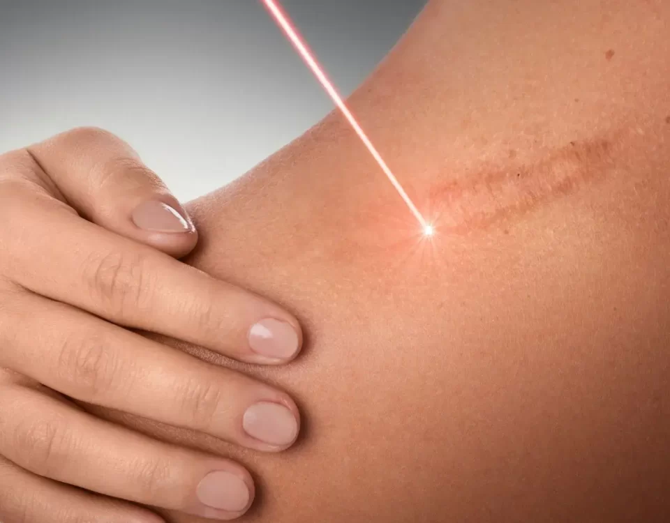 Tratamento com Laser em Guarulhos
