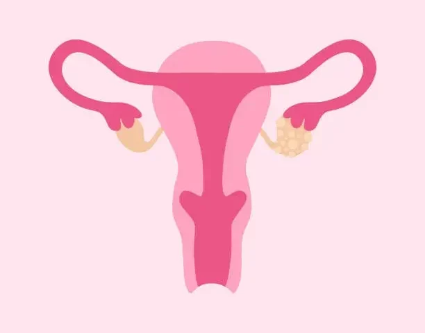 Tratamento Miomatose Uterina