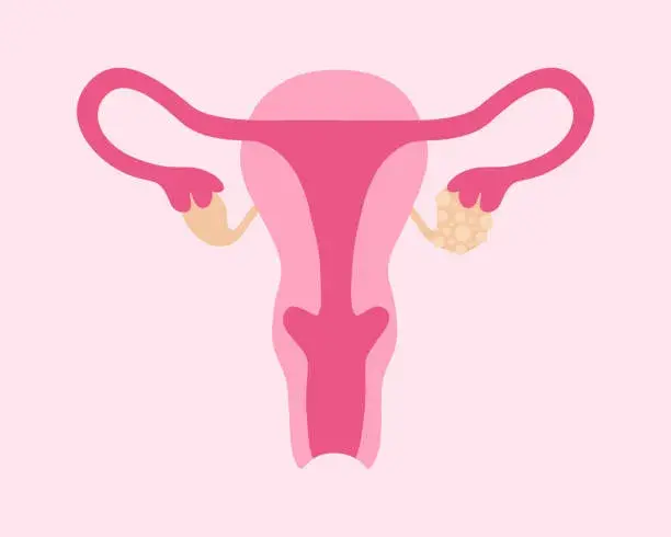 Tratamento Miomatose Uterina