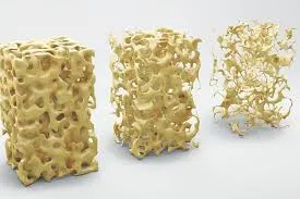 Tratamento para Osteoporose em SP