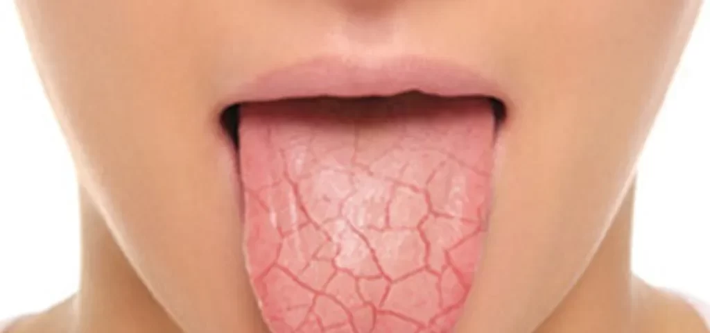 Tratamento para Síndrome de Sjögren em SP