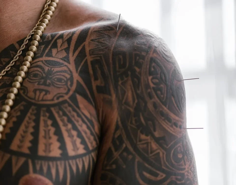 Tratamentos com Acupuntura em Guarulhos