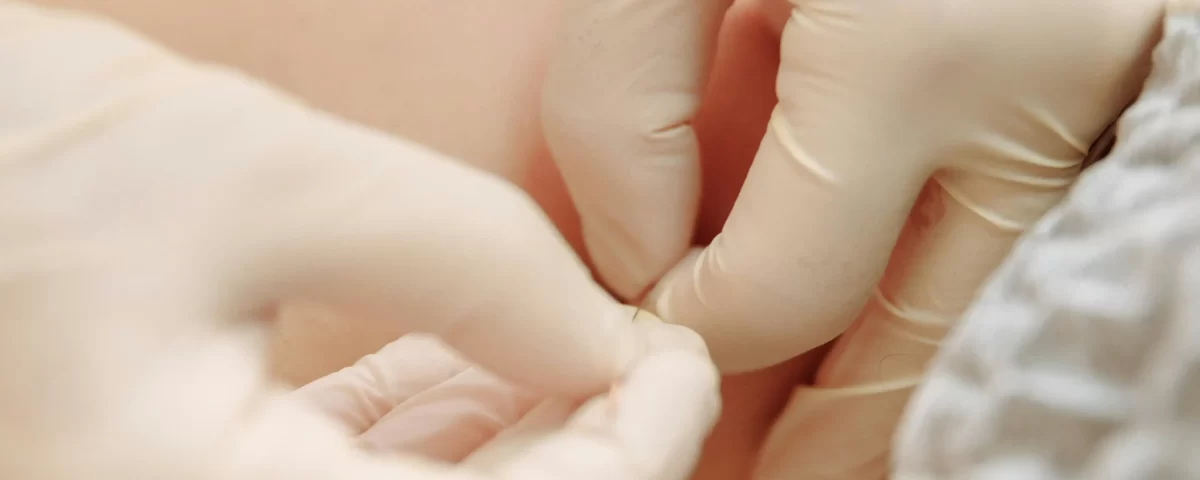 Como Funciona a Acupuntura?