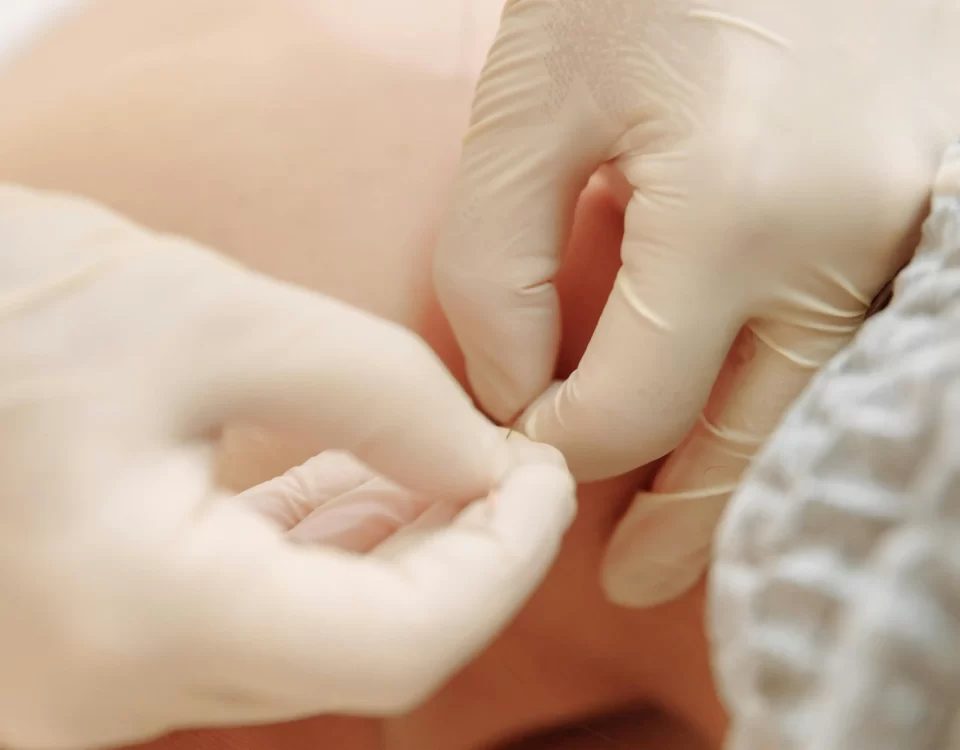 Como Funciona a Acupuntura?