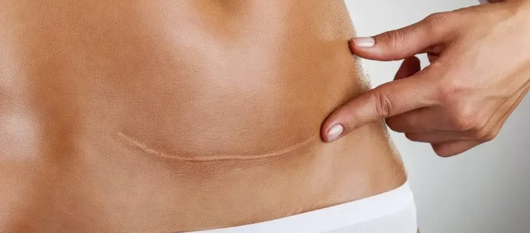 Tratamento a Laser para Cicatriz Preço