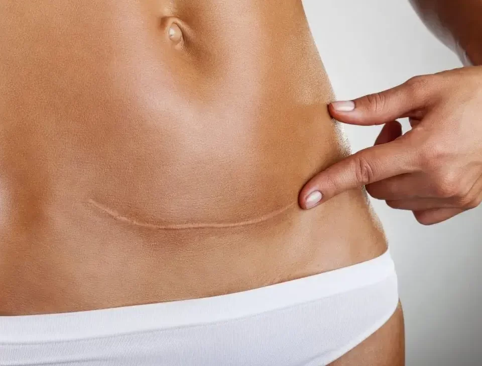 Tratamento a Laser para Cicatriz Preço