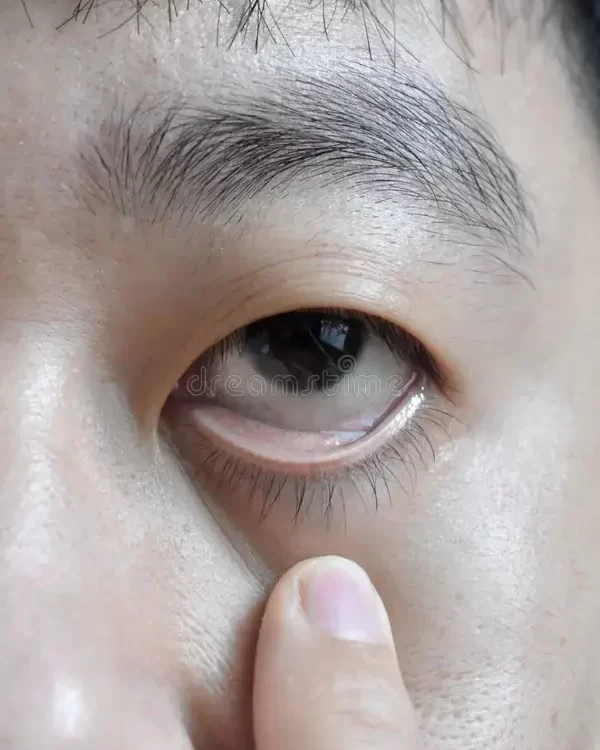 Tratamento para Anemia